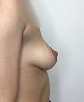 Breast Augmentation Silicone Implants Before and After | CIARAVINO Plastic Surgery