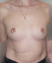 Breast Augmentation Silicone Implants Before and After | CIARAVINO Plastic Surgery