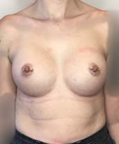 Breast Augmentation Silicone Implants Before and After | CIARAVINO Plastic Surgery