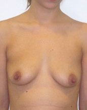 Breast Augmentation Silicone Implants Before and After | CIARAVINO Plastic Surgery