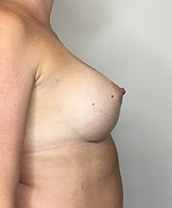 Breast Augmentation Silicone Implants Before and After | CIARAVINO Plastic Surgery