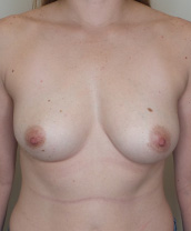 Breast Augmentation Silicone Implants Before and After | CIARAVINO Plastic Surgery