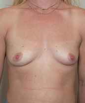 Breast Augmentation Silicone Implants Before and After | CIARAVINO Plastic Surgery