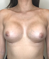 Breast Augmentation Silicone Implants Before and After | CIARAVINO Plastic Surgery