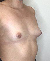 Breast Augmentation Silicone Implants Before and After | CIARAVINO Plastic Surgery