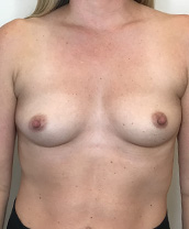 Breast Augmentation Silicone Implants Before and After | CIARAVINO Plastic Surgery