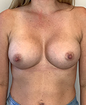 Breast Augmentation Silicone Implants Before and After | CIARAVINO Plastic Surgery