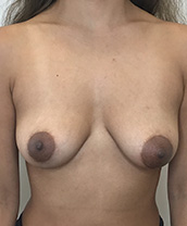 Breast Augmentation Silicone Implants Before and After | CIARAVINO Plastic Surgery