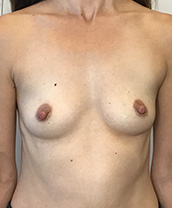 Breast Augmentation Silicone Implants Before and After | CIARAVINO Plastic Surgery