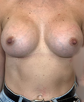 Breast Augmentation Silicone Implants Before and After | CIARAVINO Plastic Surgery