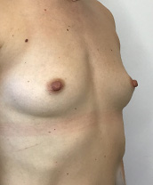 Breast Augmentation Silicone Implants Before and After | CIARAVINO Plastic Surgery