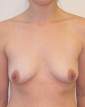 Breast Augmentation Silicone Implants Before and After | CIARAVINO Plastic Surgery