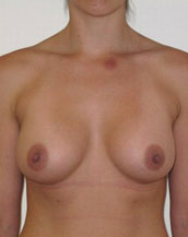 Breast Augmentation Silicone Implants Before and After | CIARAVINO Plastic Surgery