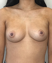 Breast Augmentation Silicone Implants Before and After | CIARAVINO Plastic Surgery