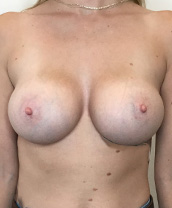 Breast Augmentation Silicone Implants Before and After | CIARAVINO Plastic Surgery