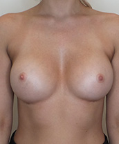 Breast Augmentation Silicone Implants Before and After | CIARAVINO Plastic Surgery