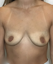 Breast Augmentation Silicone Implants Before and After | CIARAVINO Plastic Surgery