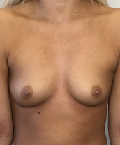 Breast Augmentation Silicone Implants Before and After | CIARAVINO Plastic Surgery