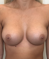 Breast Augmentation Silicone Implants Before and After | CIARAVINO Plastic Surgery