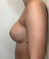 Breast Augmentation Silicone Implants Before and After | CIARAVINO Plastic Surgery