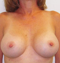 Breast Augmentation Silicone Implants Before and After | CIARAVINO Plastic Surgery