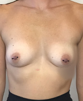 Breast Augmentation Silicone Implants Before and After | CIARAVINO Plastic Surgery