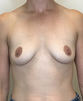 Breast Augmentation Silicone Implants Before and After | CIARAVINO Plastic Surgery