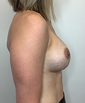 Breast Augmentation Silicone Implants Before and After | CIARAVINO Plastic Surgery