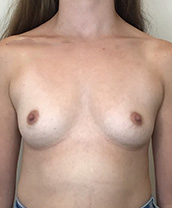 Breast Augmentation Silicone Implants Before and After | CIARAVINO Plastic Surgery