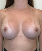 Breast Augmentation Silicone Implants Before and After | CIARAVINO Plastic Surgery