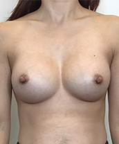 Breast Augmentation Silicone Implants Before and After | CIARAVINO Plastic Surgery