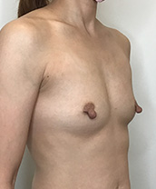 Breast Augmentation Silicone Implants Before and After | CIARAVINO Plastic Surgery