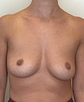 Breast Augmentation Silicone Implants Before and After | CIARAVINO Plastic Surgery