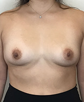 Breast Augmentation Silicone Implants Before and After | CIARAVINO Plastic Surgery