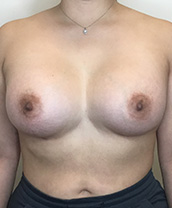 Breast Augmentation Silicone Implants Before and After | CIARAVINO Plastic Surgery