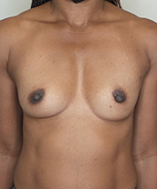 Breast Augmentation Silicone Implants Before and After | CIARAVINO Plastic Surgery