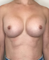 Breast Augmentation Silicone Implants Before and After | CIARAVINO Plastic Surgery