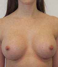 Breast Augmentation Silicone Implants Before and After | CIARAVINO Plastic Surgery