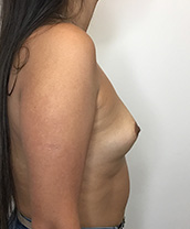 Breast Augmentation Silicone Implants Before and After | CIARAVINO Plastic Surgery