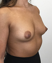 Breast Augmentation Silicone Implants Before and After | CIARAVINO Plastic Surgery