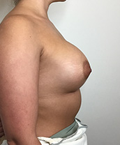 Breast Augmentation Silicone Implants Before and After | CIARAVINO Plastic Surgery