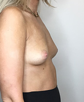 Breast Augmentation Silicone Implants Before and After | CIARAVINO Plastic Surgery