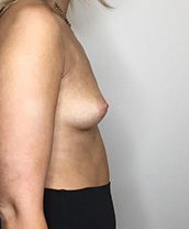 Breast Augmentation Silicone Implants Before and After | CIARAVINO Plastic Surgery