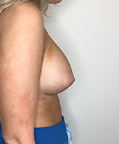 Breast Augmentation Silicone Implants Before and After | CIARAVINO Plastic Surgery