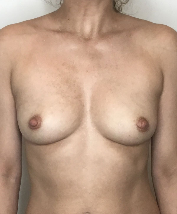 Breast Augmentation Silicone Implants Before and After | CIARAVINO Plastic Surgery