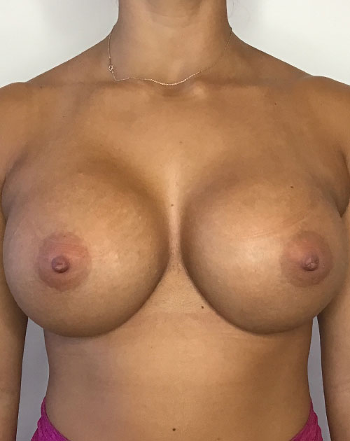 Breast Augmentation Silicone Implants Before and After | CIARAVINO Plastic Surgery