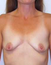 Breast Augmentation Silicone Implants Before and After | CIARAVINO Plastic Surgery