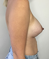 Breast Augmentation Silicone Implants Before and After | CIARAVINO Plastic Surgery