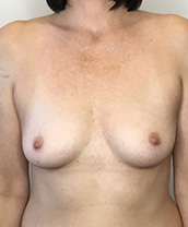 Breast Augmentation Silicone Implants Before and After | CIARAVINO Plastic Surgery