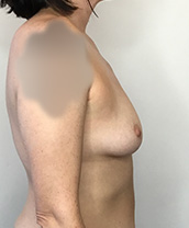 Breast Augmentation Silicone Implants Before and After | CIARAVINO Plastic Surgery